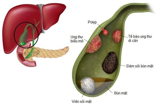 Polyp Túi Mật Là Gì? 1 Polyp túi mật là gì?