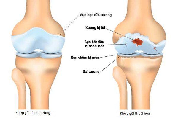 Đau nhức xương khớp: Nỗi ám ảnh của tuổi già và giải pháp từ thiên nhiên 3 Bệnh Xương Khớp