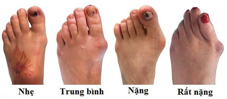 Bệnh Gút: Từ Hiểu Biết đến Chiến Thắng Cơn Đau 2 Các Giai đoạn Của Bệnh Gút