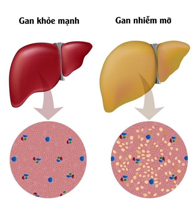Cách Trị Gan Nhiễm Mỡ Tại Nhà: Hướng Dẫn Toàn Diện và Hiệu Quả 1 Gan Nhiễm Mỡ