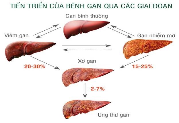 Cách Trị Gan Nhiễm Mỡ Tại Nhà: Hướng Dẫn Toàn Diện và Hiệu Quả 2 Gan Nhiễm Mỡ Có Nguy Hiểm Không