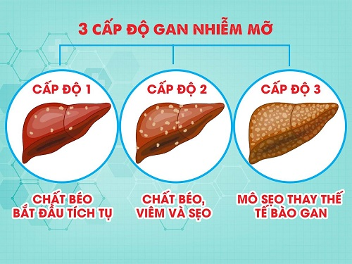 Gan nhiễm mỡ độ 1: Cánh cửa mở ra cơ hội thay đổi lối sống tích cực 1 Gan nhiễm mỡ độ 1 là giai đoạn nhẹ nhất và dễ phục hồi