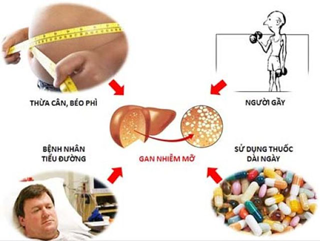 Gan nhiễm mỡ độ 1: Cánh cửa mở ra cơ hội thay đổi lối sống tích cực 2 Nguyên nhân gây gan nhiễm mỡ độ 1 do chế độ ăn và lười vận động