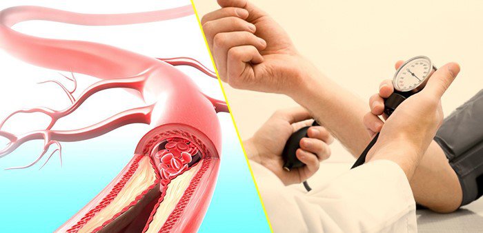 Cách Trị Tăng Huyết Áp Tại Nhà: Hướng Dẫn Toàn Diện 1 cách trị tăng huyết áp tại nhà