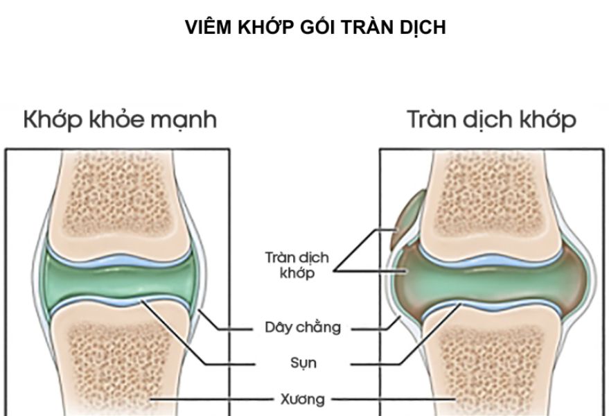 Tràn dịch khớp gối, đau khớp gối: Khi "bản lề" cơ thể lên tiếng kêu cứu 1 Tran Dich Khop Goi