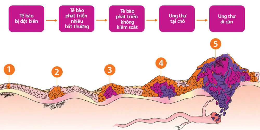 Ung Thư & Xạ Trị: Hiểu Rõ Hơn Về Bệnh Và Phương Pháp Điều Trị, Nấm Lim Xanh - Tia Hy Vọng Từ Thiên Nhiên 1 Ung Thư Là Gì