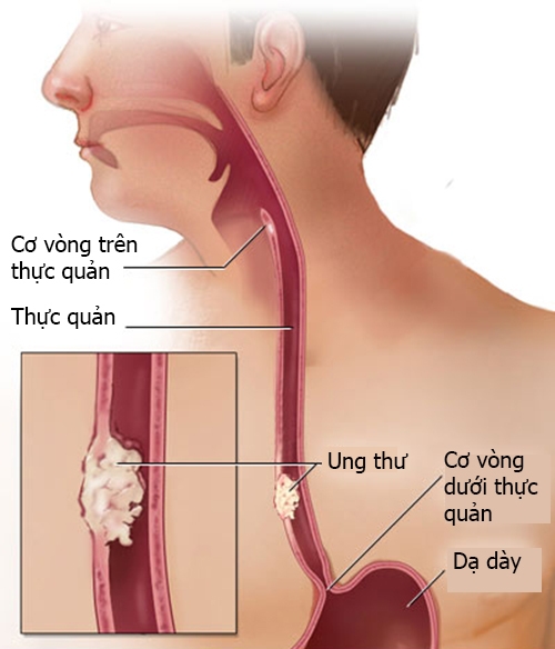 Ung thư thực quản: 8 Dấu hiệu ung thư thực quản 1 Ung Thư Thực Quản 1