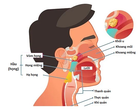 Triệu chứng Ung thư: Tổng quan và Những Điều Cần Biết 2 triệu chứng Ung Thư Vòm Họng