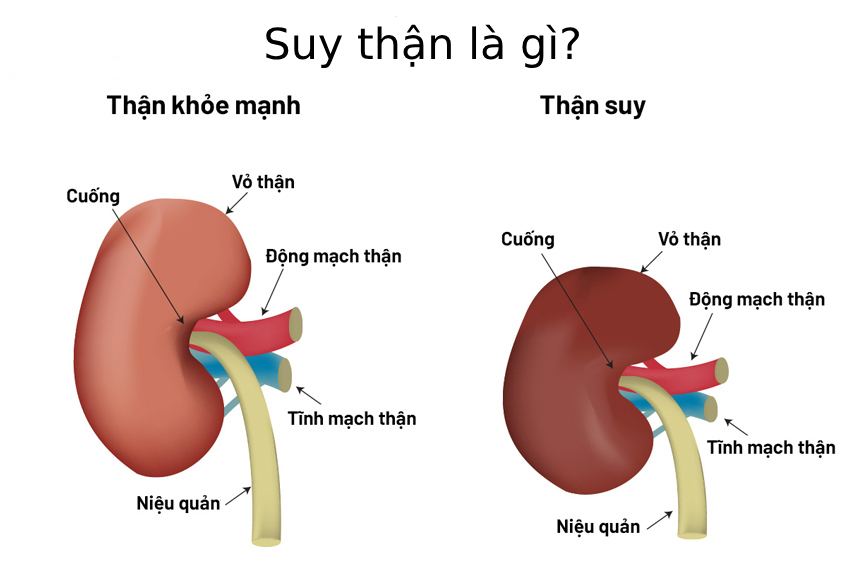 Suy Thận: Căn Bệnh Thầm Lặng Và Hành Trình Tìm Kiếm Giải Pháp Từ Thiên Nhiên 1 Suy thận là gì