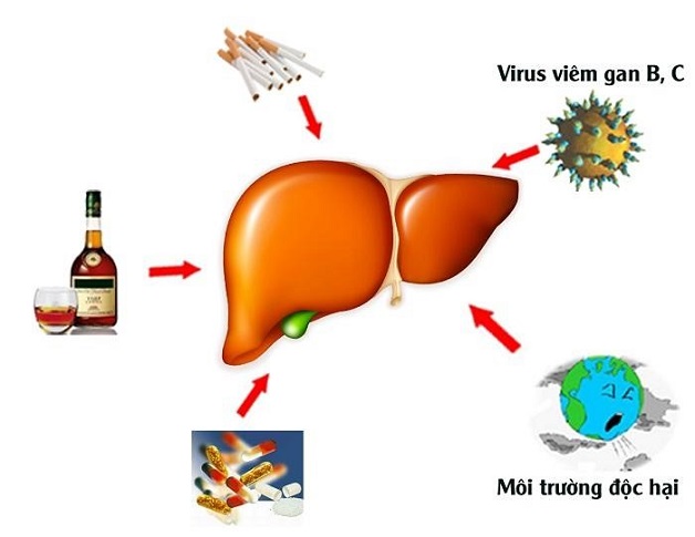 Xơ gan: Thử thách và Hy vọng 3 Bệnh Xơ Gan Có Lây Không