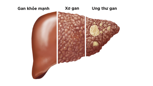 Xơ gan: Thử thách và Hy vọng 1 Xơ Gan