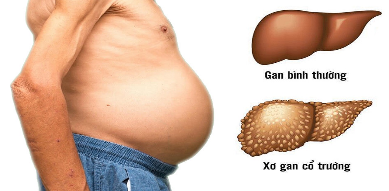 Xơ gan: Thử thách và Hy vọng 2 Xơ Gan Cổ Trướng
